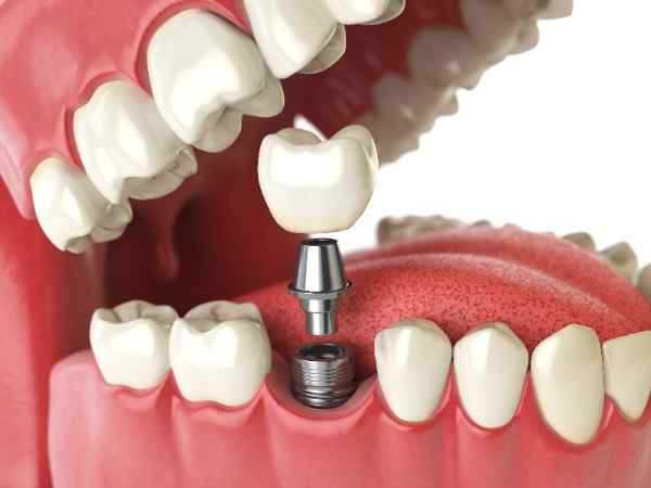 dental implants Andover