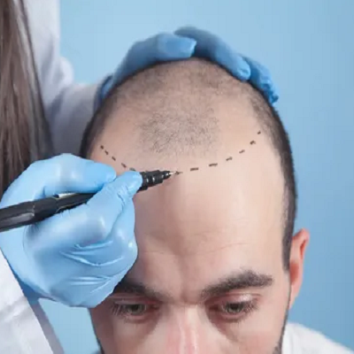 تكلفة زراعة الشعر في الرياض 2025