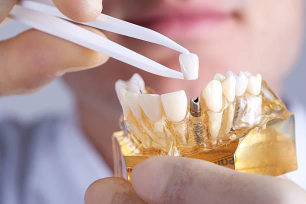 Are Dental Implants Worth the Investment for Long-Term... - Hasster