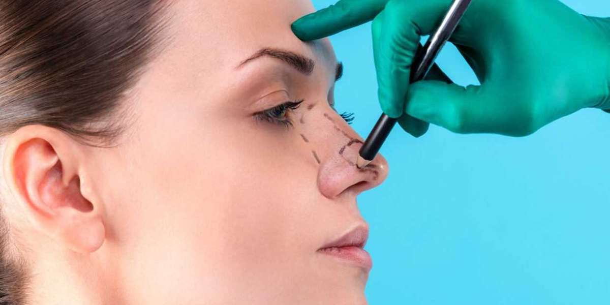 Recovery Timeline: What to Expect After Rhinoplasty