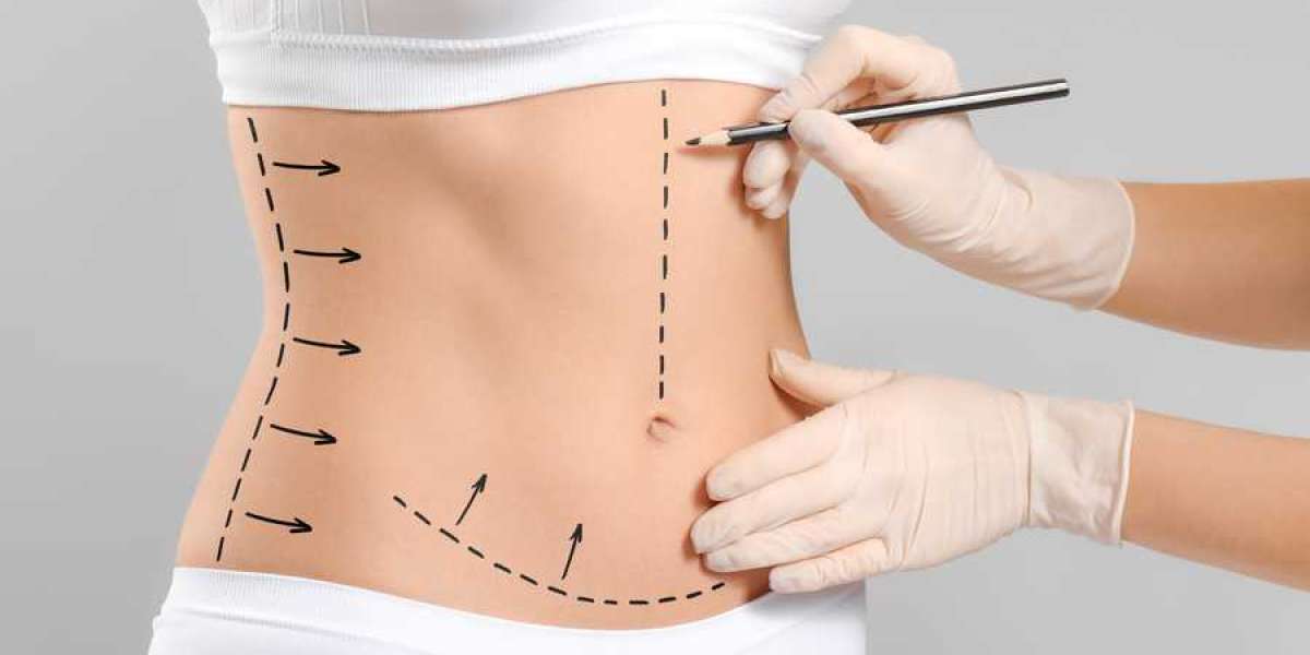 Who is an ideal candidate for liposuction in Riyadh