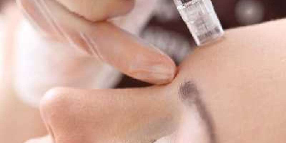 PRP Microneedling for Dull Skin Dubai – Natural Skin Rejuvenation and Glow Restoration Guide