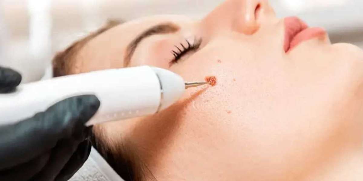 Recovery Timeline After Mole Removal in Riyadh