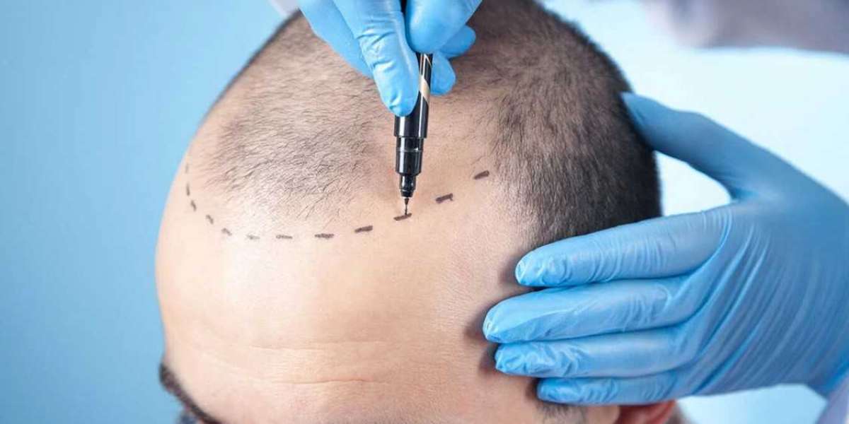 Seasonal Variations in Hair Transplant Costs