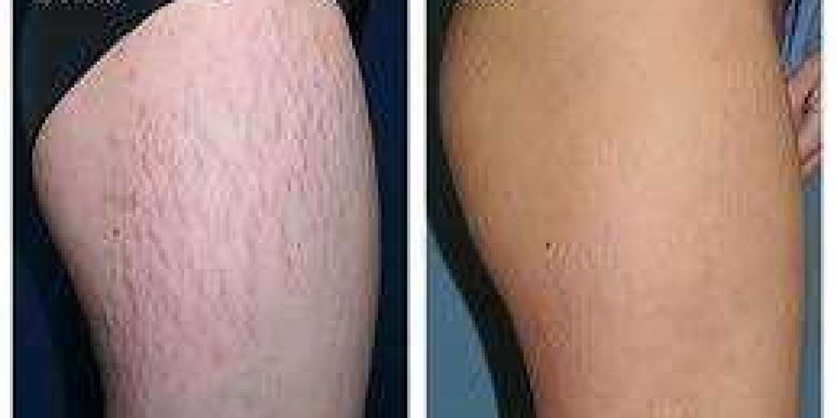 Dermatology Clinics Specializing in Stretch Marks Dubai – Advanced Skin Care Solutions