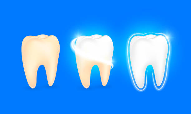 How Teeth Whitening Can Instantly Improve Your Confidence – Telegraph