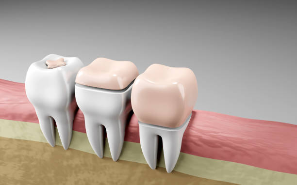 Dental Crowns vs Fillings: Which Is the Better Option? – Telegraph