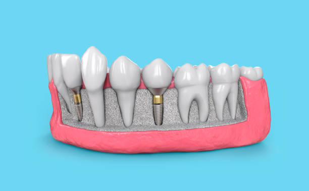 Single Tooth Implants vs Bridges: What Dental Professionals Don’t Always Tell You – Telegraph